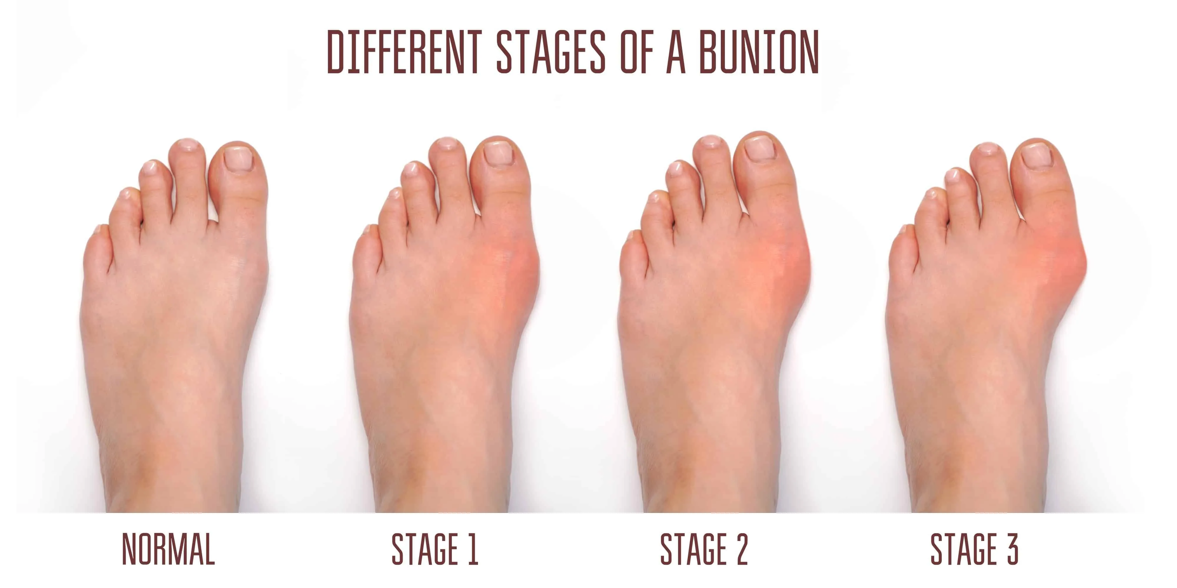 Different stages of Bunions 