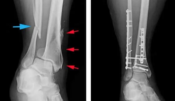 Nonunion Fracture